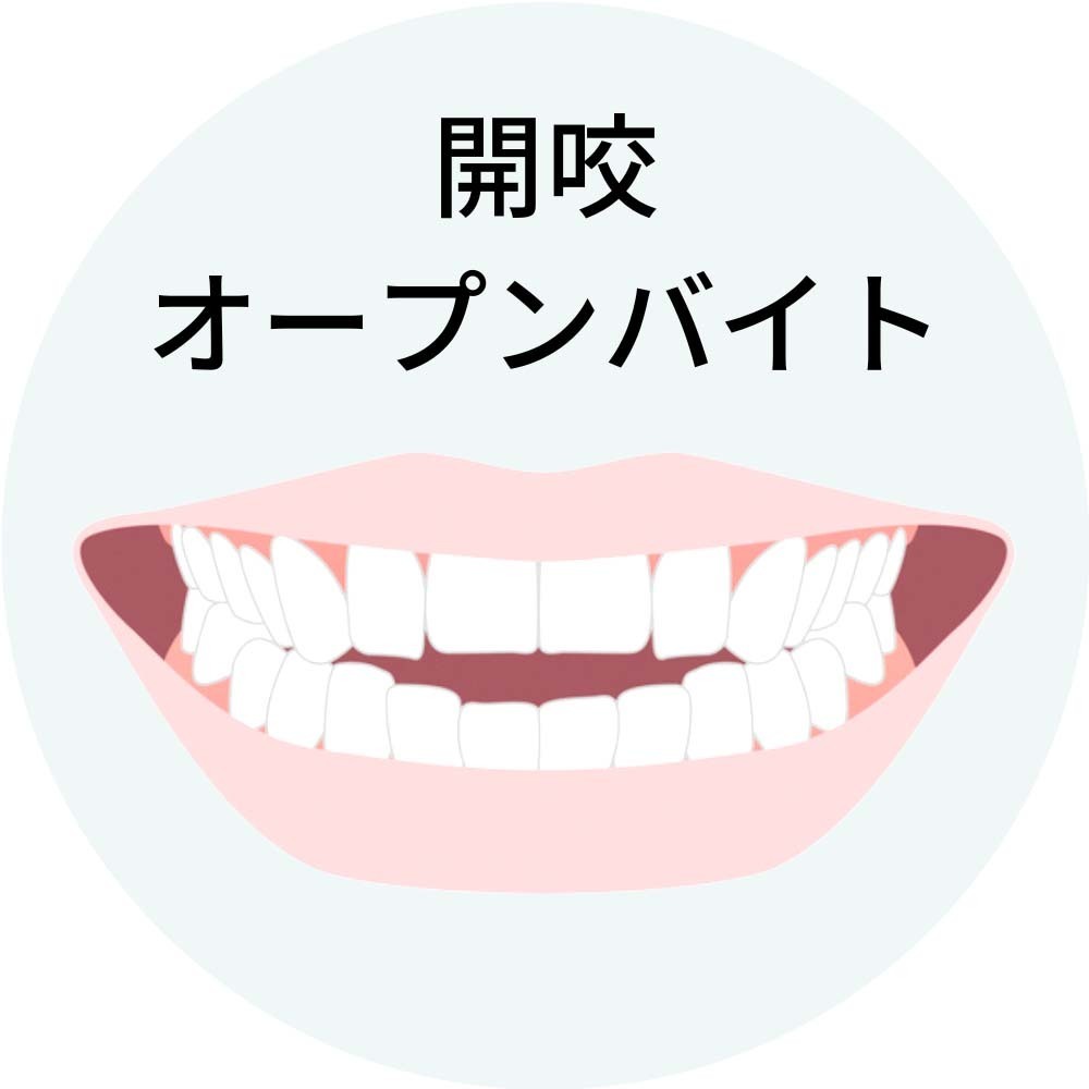 開咬