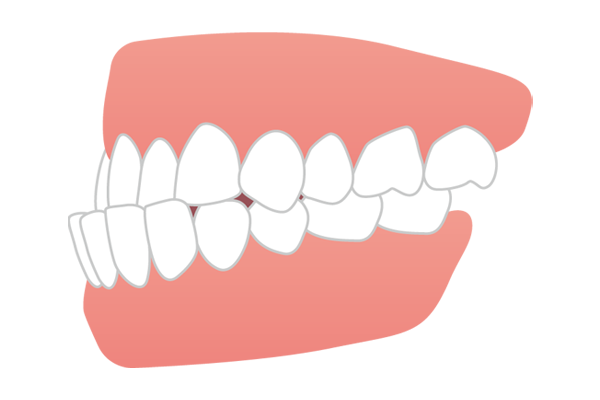 下あごが前に突き出た受け口・しゃくれ（反対咬合・下顎前突）のイラスト