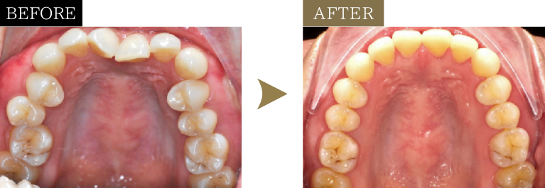 前歯のねじれ・ガタガタ（非抜歯）の矯正治療のビフォーアフター写真