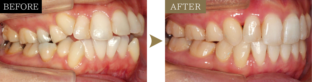八重歯・ガタガタの矯正治療のビフォーアフター写真