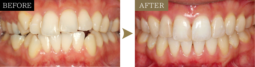八重歯・ガタガタの矯正治療のビフォーアフター写真