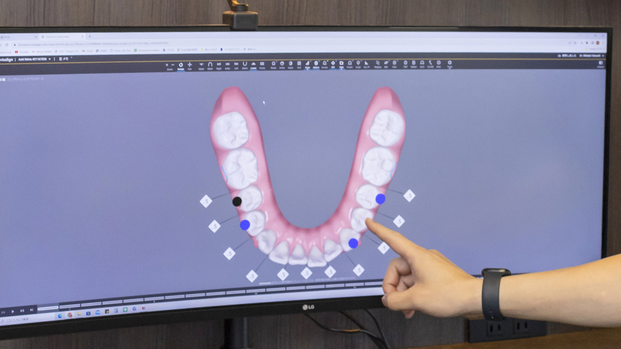 精密な治療計画のシミュレーション画面