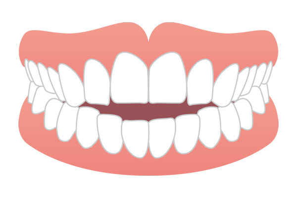 奥歯は噛み合うが前歯が噛み合わない開咬（オープンバイト）のイラスト