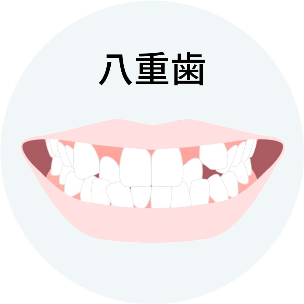 八重歯