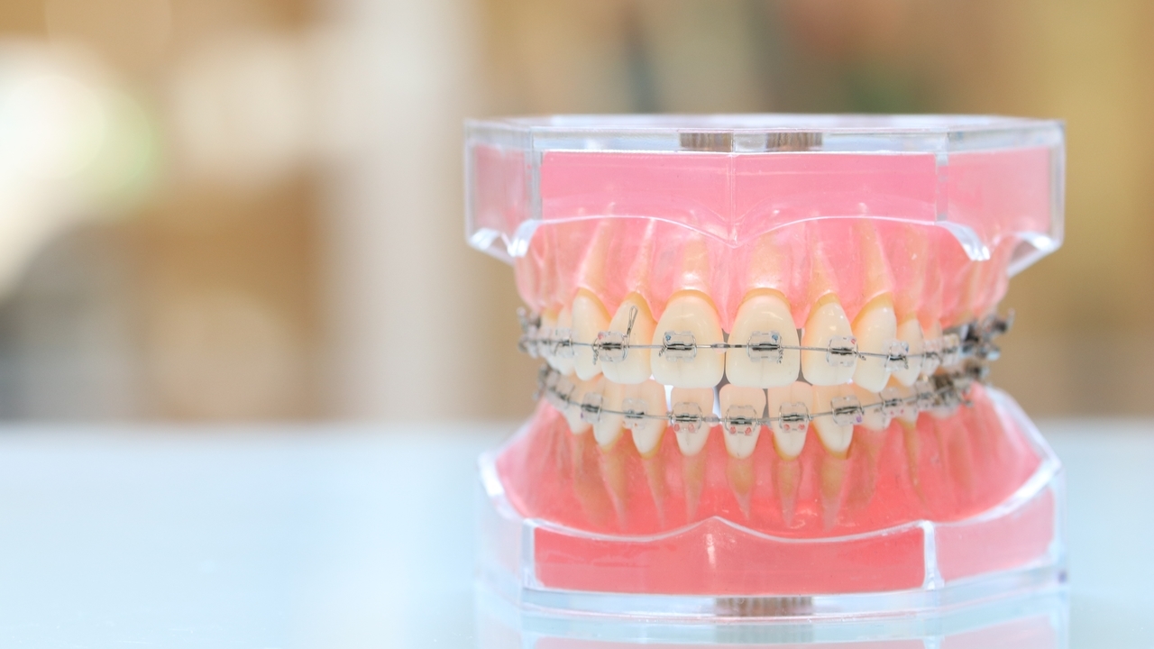 ワイヤー矯正の模型とインビザラインの透明なマウスピース