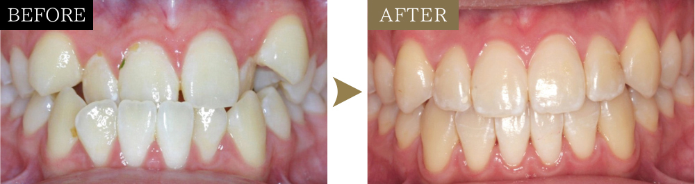 受け口（反対咬合）の治療前後の比較写真