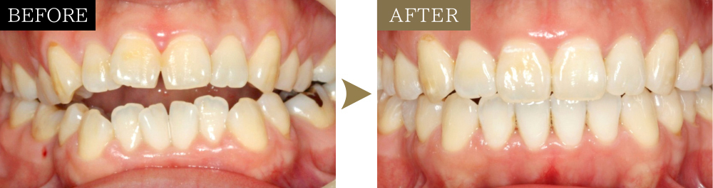 開咬（オープンバイト）の治療前後の比較写真