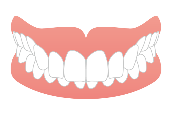 上の歯が下の歯に大きく被さった過蓋咬合（ディープバイト）のイラスト