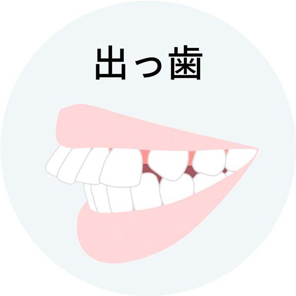出っ歯