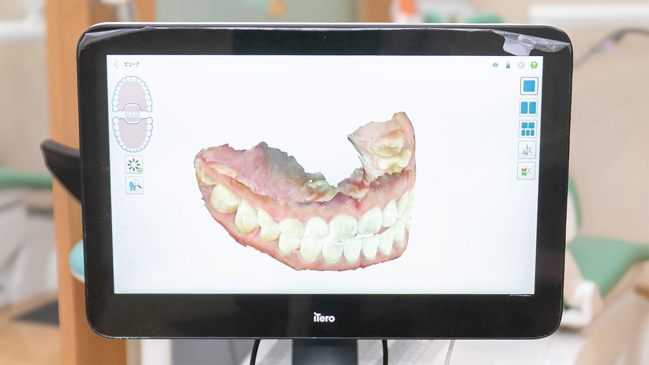 矯正前の歯並びと矯正後の歯並びのシミュレーション画像