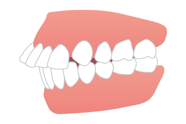上の前歯が突き出た出っ歯（上顎前突）のイラスト