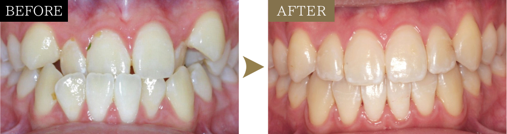 受け口（非抜歯）の矯正治療のビフォーアフター写真