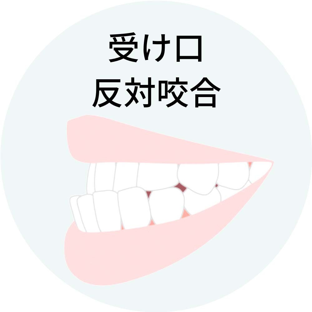 受け口