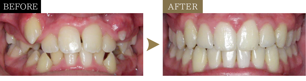 八重歯と叢生の治療前後の比較写真