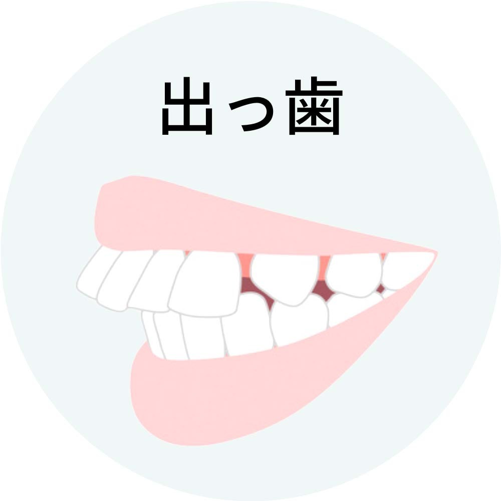 出っ歯