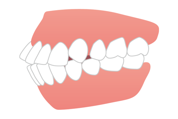 口元が前に飛び出している口ゴボ（上下顎前突）のイラスト