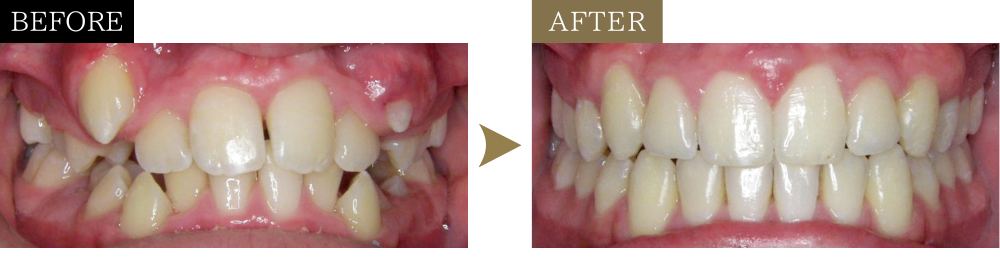 八重歯・ガタガタ（非抜歯・小児矯正）の矯正治療のビフォーアフター写真