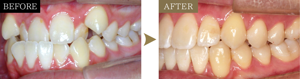 受け口（非抜歯）の矯正治療のビフォーアフター写真