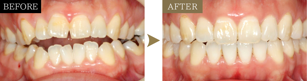 開咬（非抜歯）の矯正治療のビフォーアフター写真
