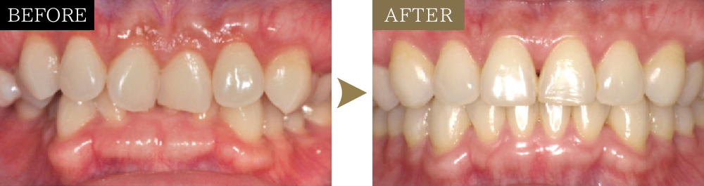 前歯の捻転・叢生と過蓋咬合の治療前後の比較写真