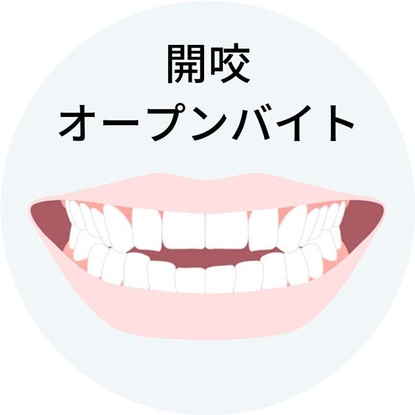 開咬
