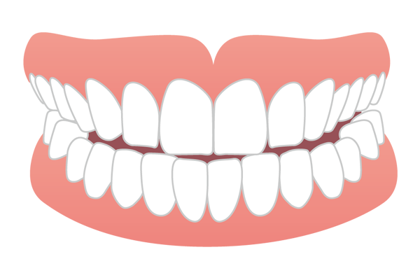 上の前歯と下の前歯の先端がぶつかる切端咬合のイラスト